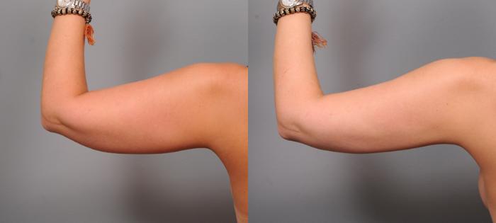 Before & After Liposuction Case 154 View #1 View in New York, NY