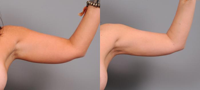 Before & After Liposuction Case 154 View #2 View in New York, NY
