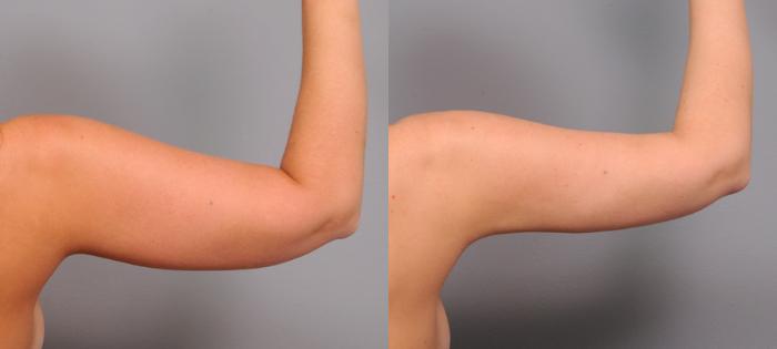 Before & After Arm Liposuction Case 154 View #3 View in New York, NY