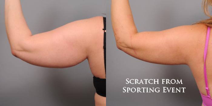 Before & After Arm Liposuction Case 159 View #2 View in New York, NY
