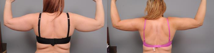 Before & After Arm Liposuction Case 159 View #4 View in New York, NY
