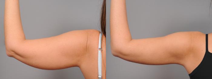 Before & After Arm Liposuction Case 43 View #1 View in New York, NY