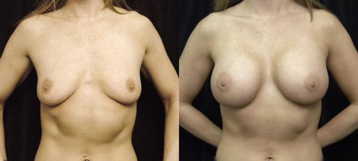 Before & After Breast Augmentation Case 138 View #1 View in New York, NY