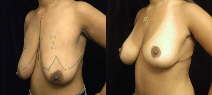 Before & After Breast Lift Case 90 View #2 View in New York, NY