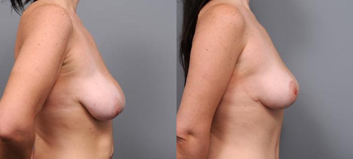 Before & After Breast Lift Case 93 View #4 View in New York, NY