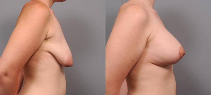 Before & After Breast Lift Case 99 View #3 View in New York, NY