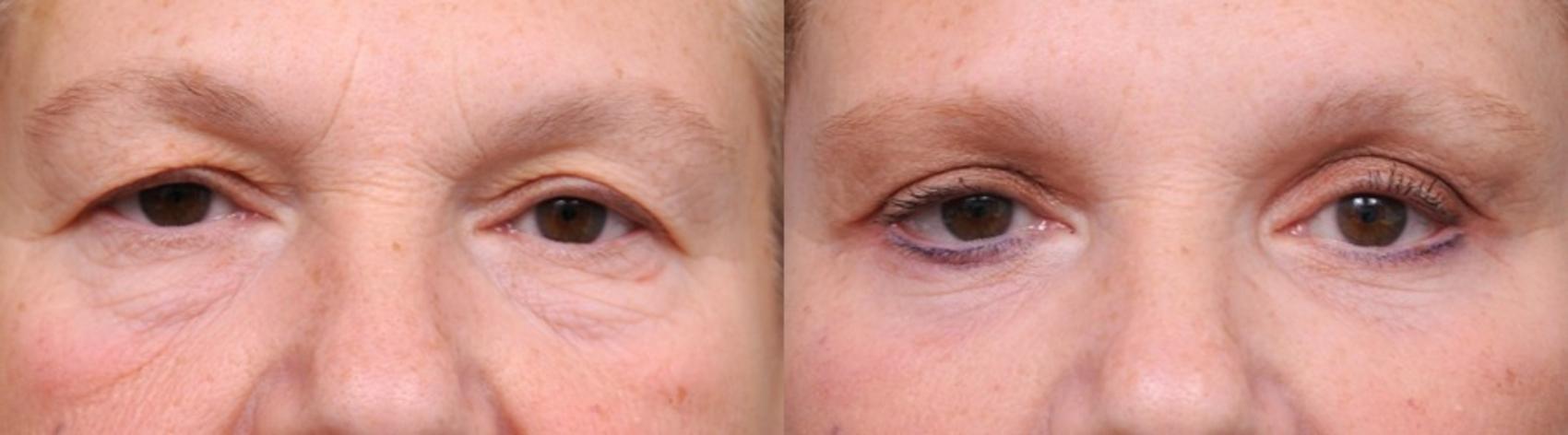 Before & After Eyelid Surgery Case 22 View #1 View in New York, NY