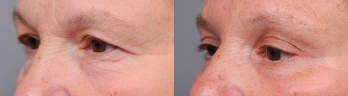Before & After Eyelid Surgery Case 22 View #2 View in New York, NY