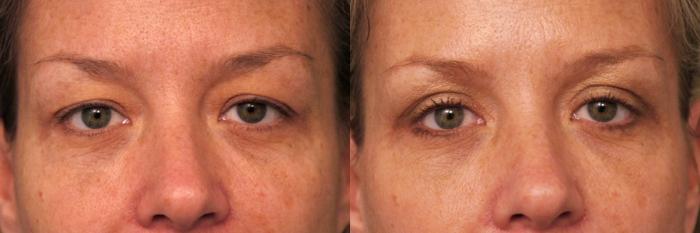 Before & After Eyelid Surgery Case 27 View #1 View in New York, NY