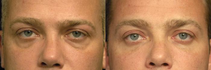 Before & After Eyelid Surgery for Men Case 25 View #1 View in New York, NY
