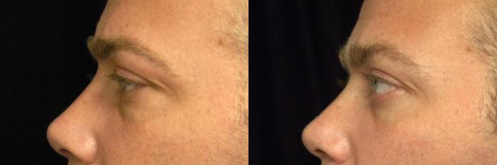 Before & After Eyelid Surgery for Men Case 25 View #2 View in New York, NY