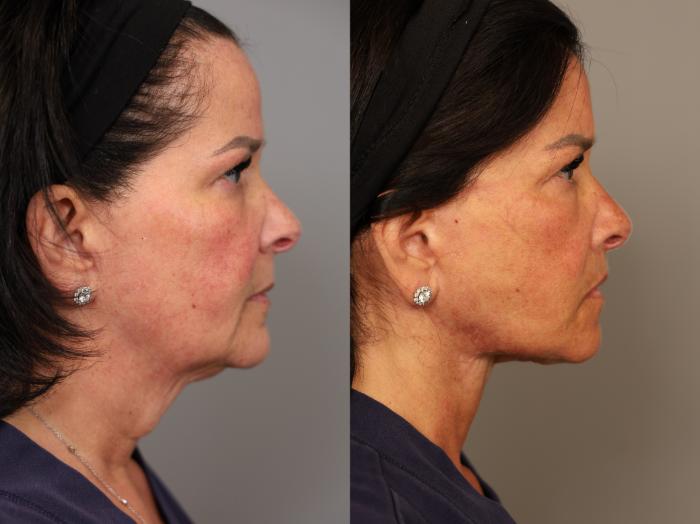 Before & After Facelift Case 292 Left Side View in New York, NY