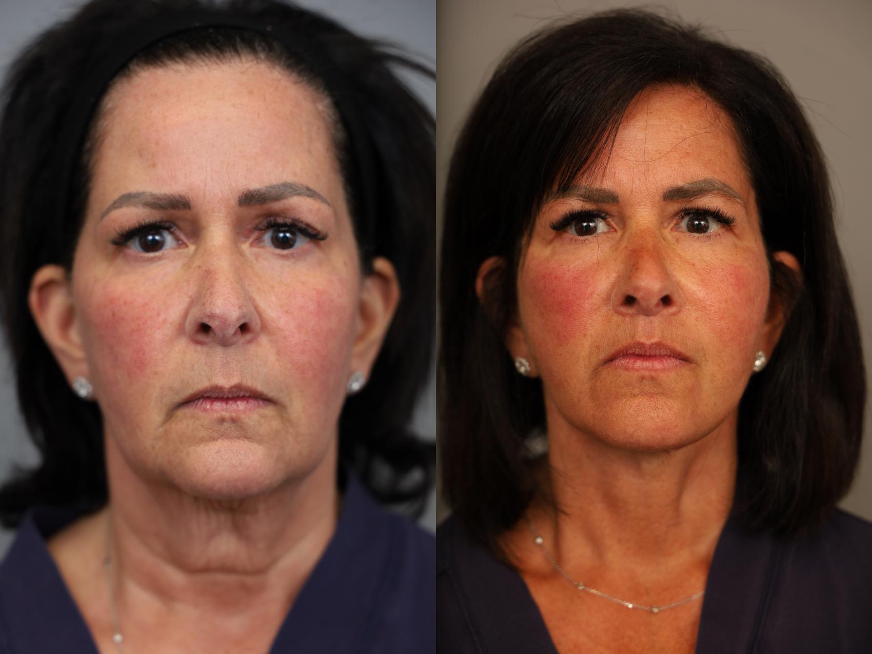 Facelift