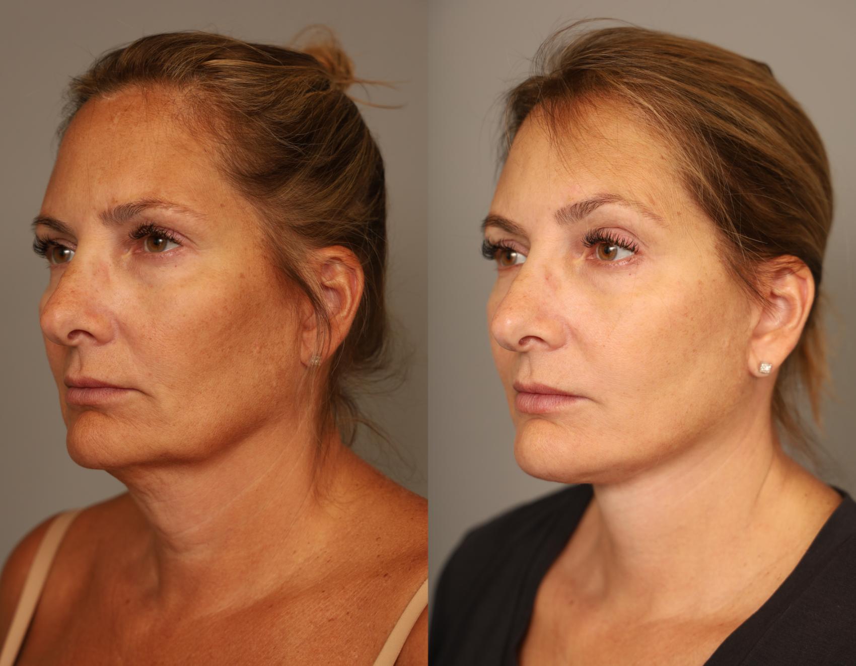 Before & After Facelift Case 306 Left Side View in New York, NY