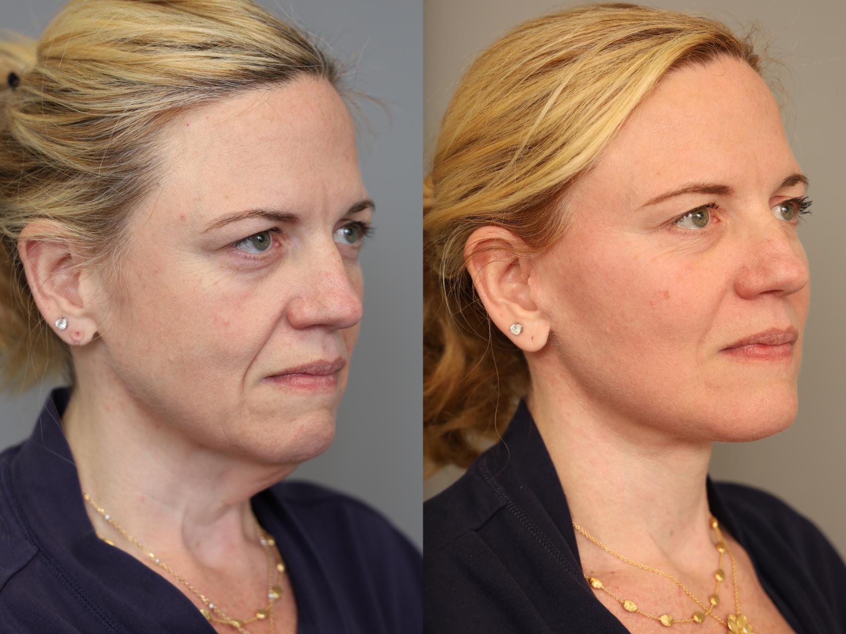 Before & After Facelift Case 307 Left Side View in New York, NY