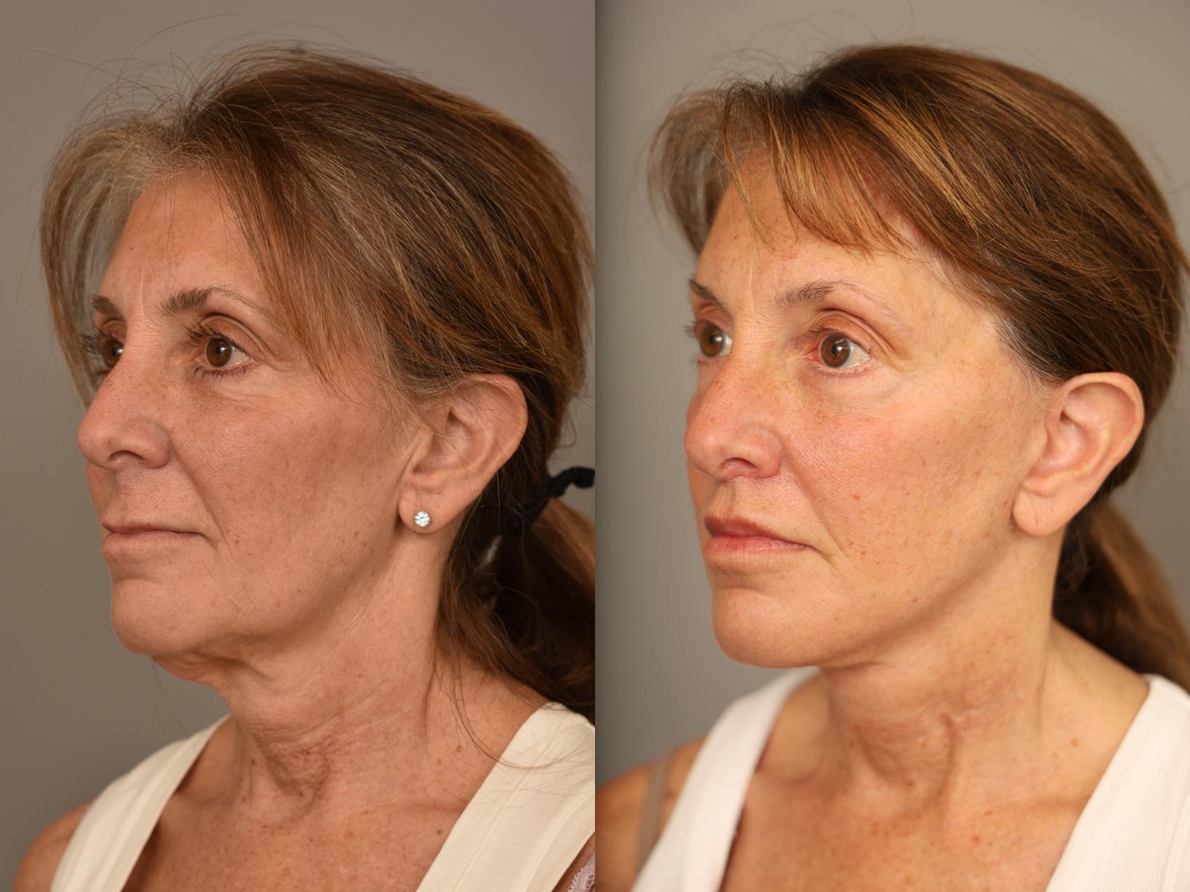 Before & After Facelift Case 311 Front View in New York, NY
