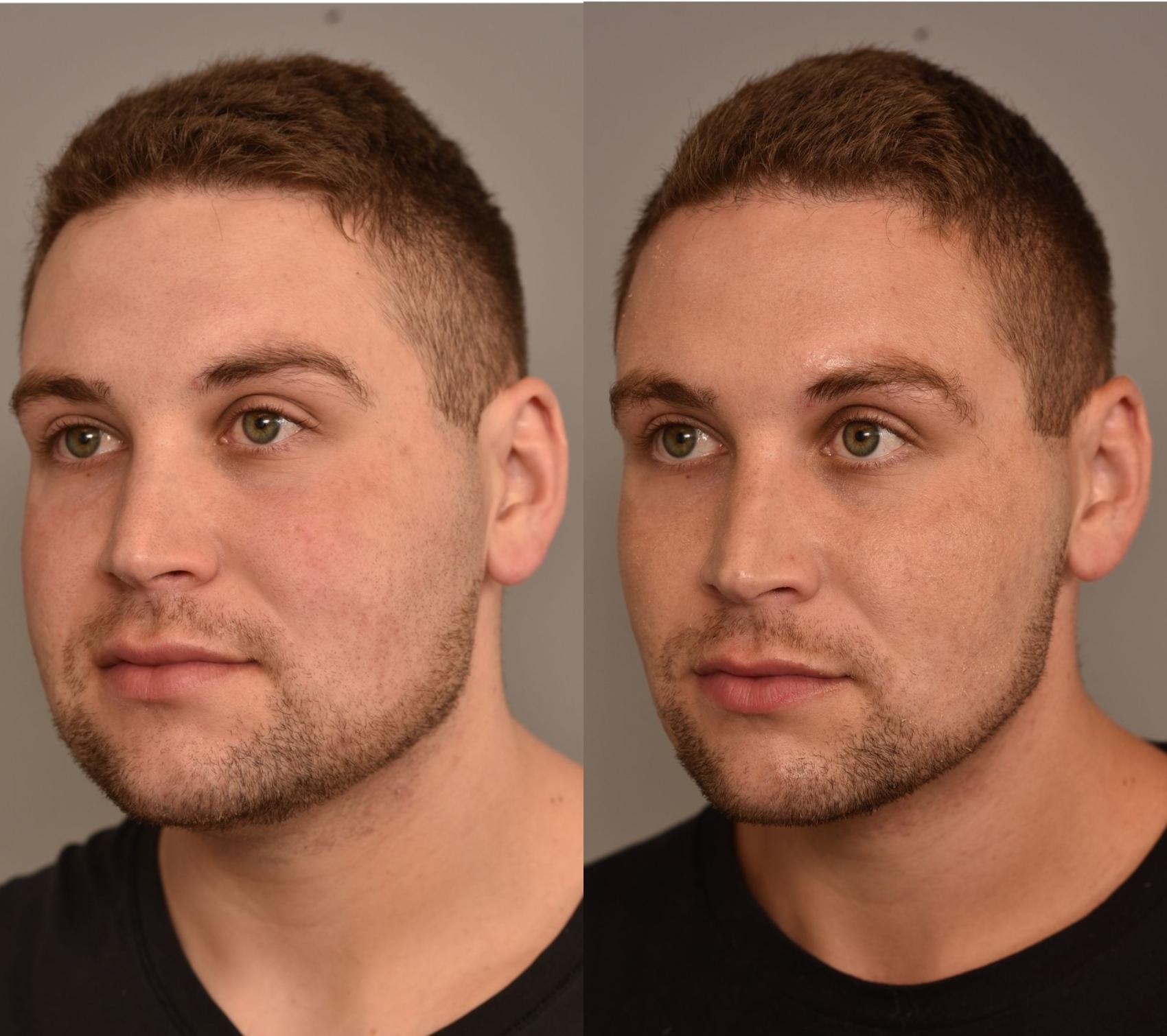 Before & After Facial Contouring Case 260 Left Oblique View in New York, NY