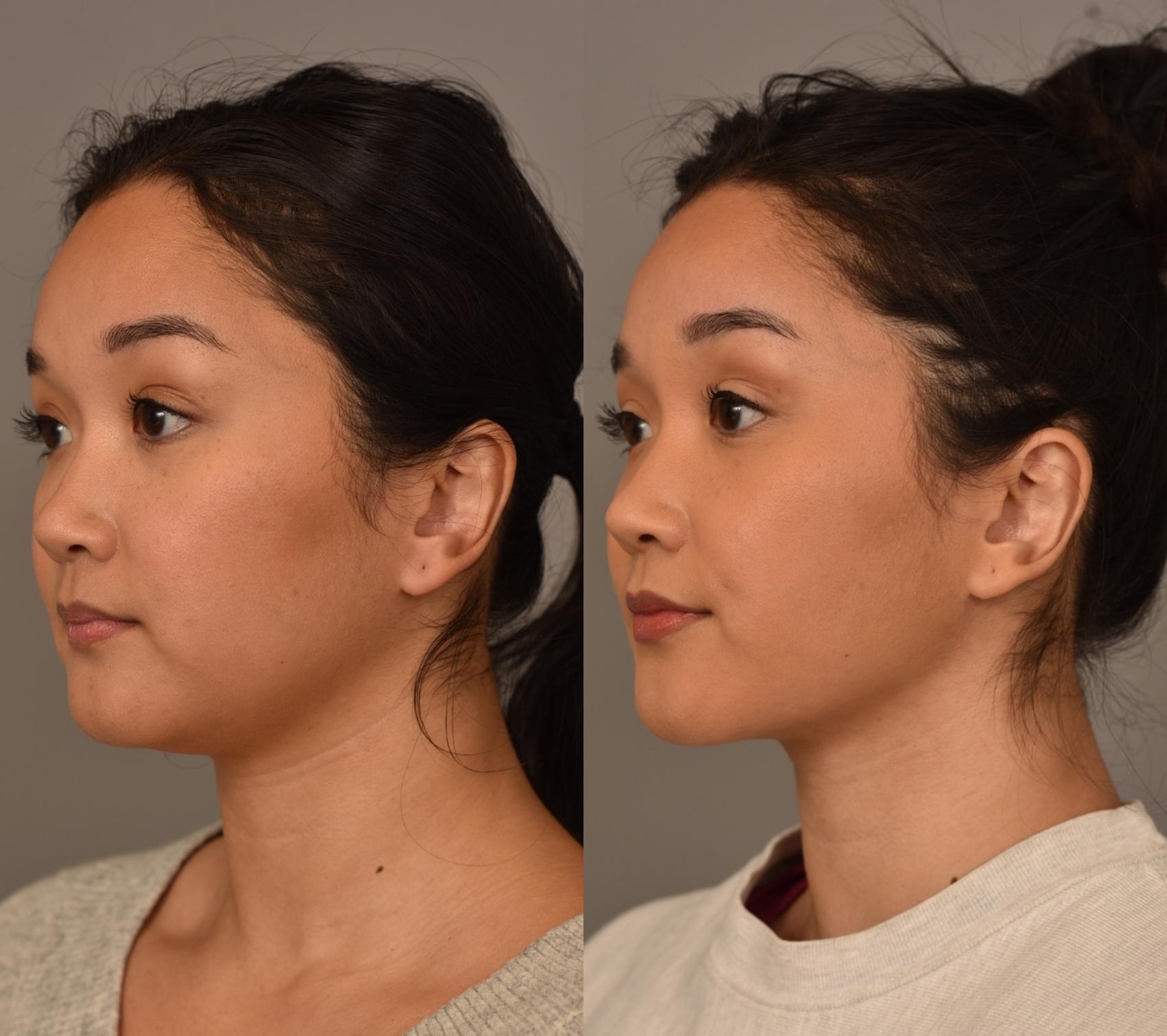 Before & After Facial Contouring Case 261 Left Oblique View in New York, NY