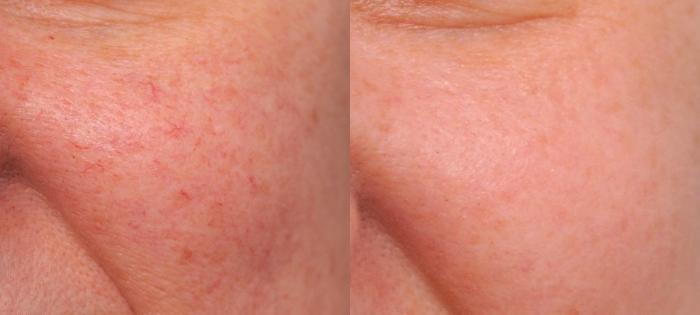 Before & After IPL Photofacial Case 84 View #2 View in New York, NY