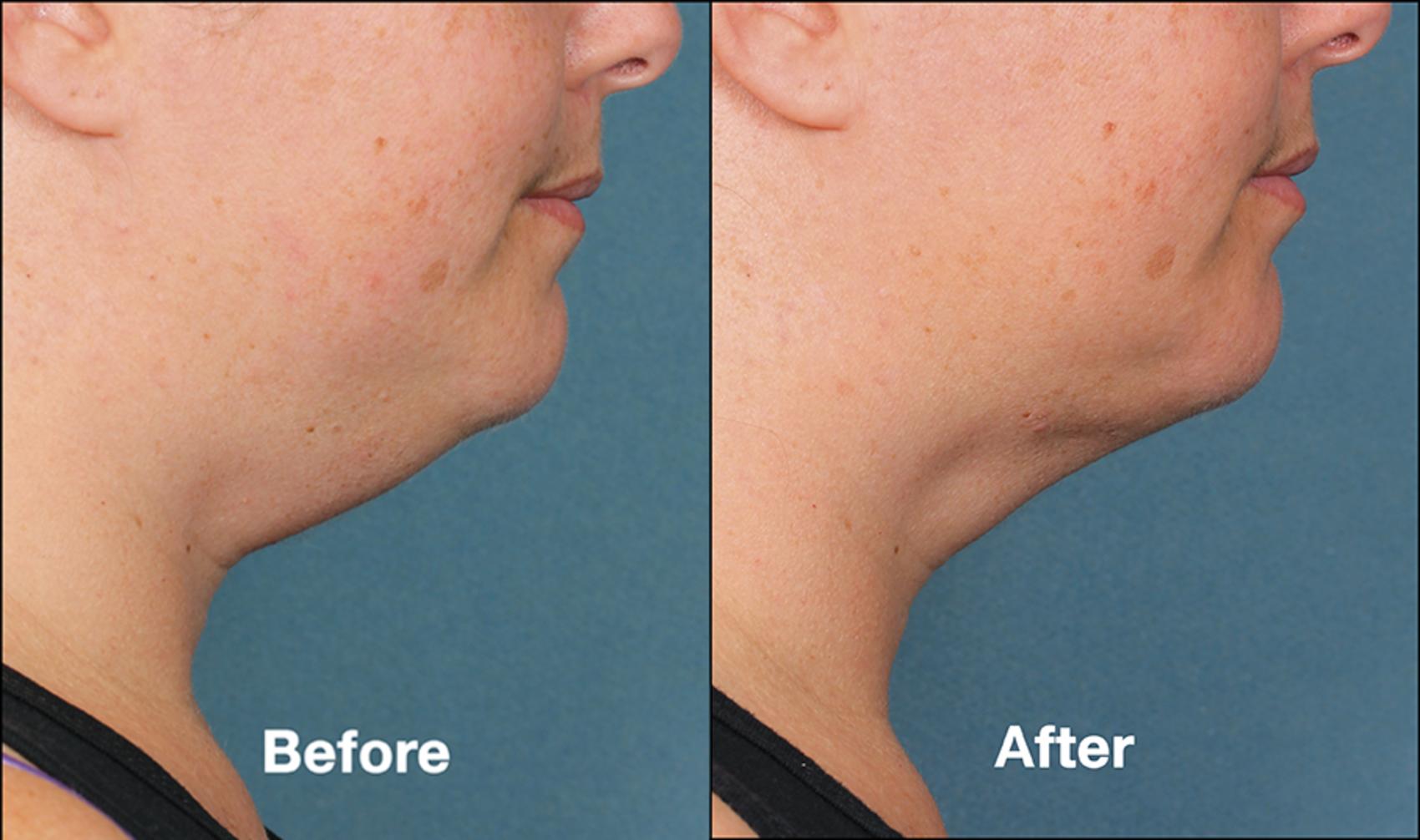 Before & After Kybella® Case 178 View #1 View in New York, NY