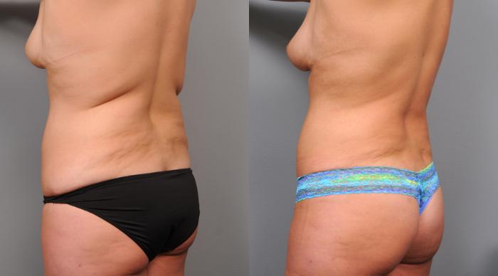 Before & After Liposuction Case 157 View #2 View in New York, NY