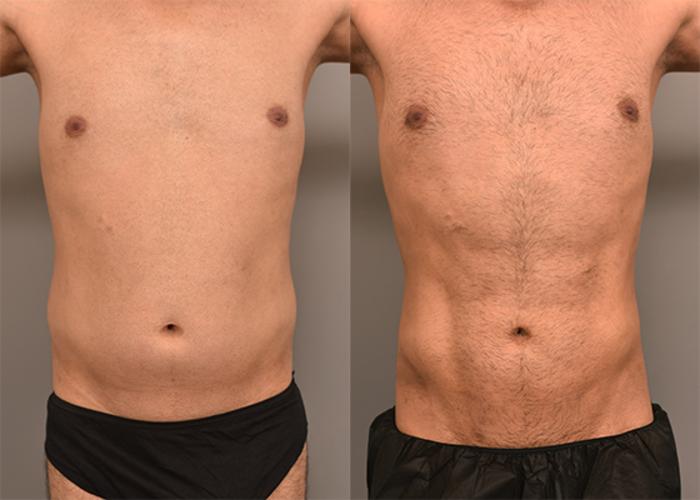 Before & After Liposuction for Men Case 240 View #1 View in New York, NY