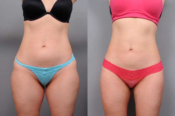 Before & After Liposuction Case 35 View #1 View in New York, NY