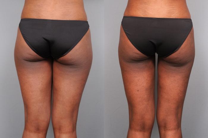 Before & After Liposuction Case 36 View #2 View in New York, NY