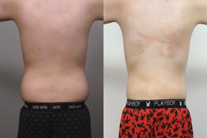 Before & After Liposuction for Men Case 34 View #2 View in New York, NY