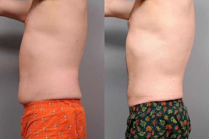 Before & After Liposuction for Men Case 47 View #3 View in New York, NY
