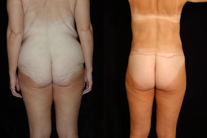 Before & After Lower Body Lift Case 125 View #3 View in New York, NY