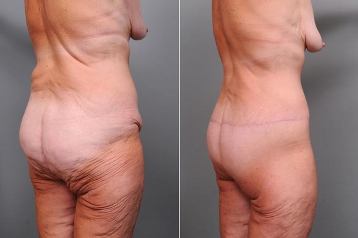 Before & After Lower Body Lift Case 128 View #4 View in New York, NY