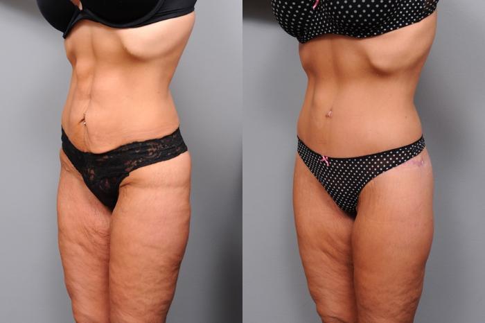 Before & After Lower Body Lift Case 134 View #2 View in New York, NY