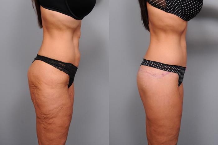 Before & After Lower Body Lift Case 134 View #5 View in New York, NY