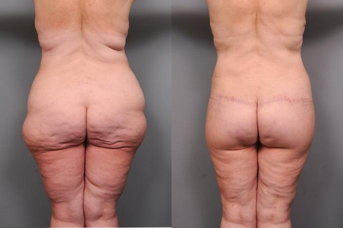 Before & After Lower Body Lift Case 135 View #5 View in New York, NY