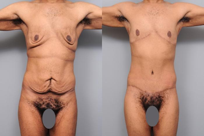Before & After Lower Body Lift for Men Case 130 View #1 View in New York, NY
