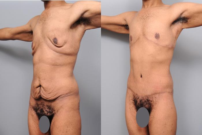 Before & After Lower Body Lift for Men Case 130 View #2 View in New York, NY