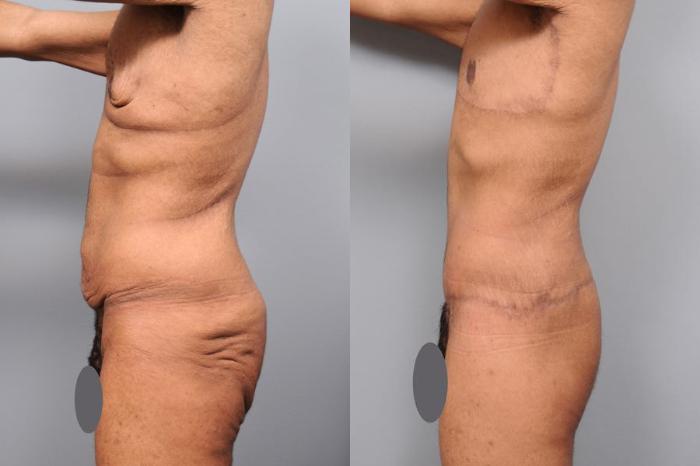 Before & After Lower Body Lift for Men Case 130 View #3 View in New York, NY
