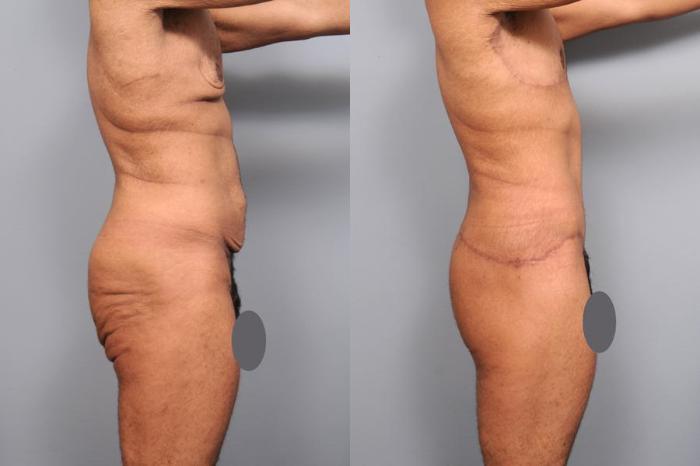 Before & After Lower Body Lift for Men Case 130 View #5 View in New York, NY