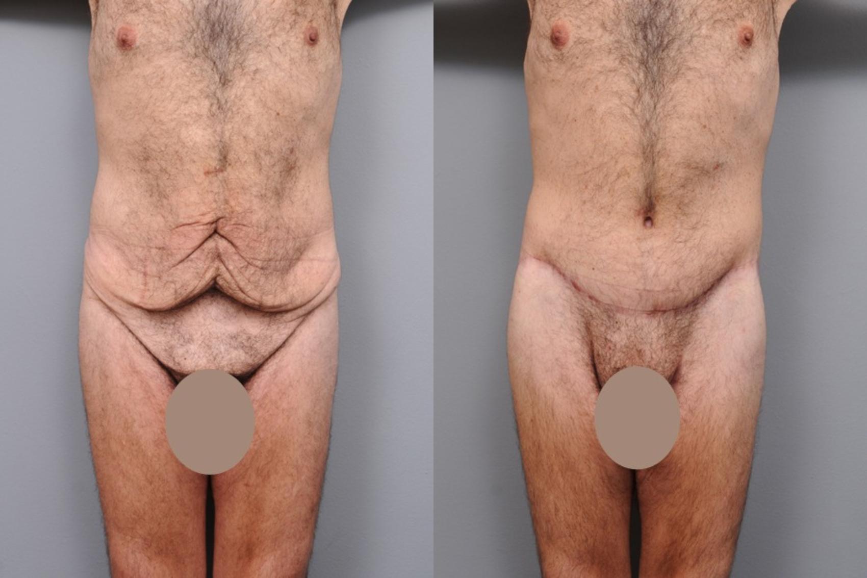 Before & After Lower Body Lift for Men Case 132 View #1 View in New York, NY
