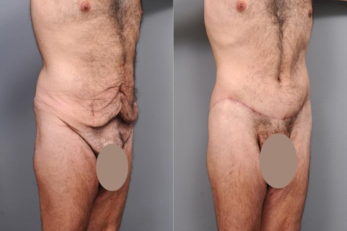 Before & After Lower Body Lift for Men Case 132 View #2 View in New York, NY