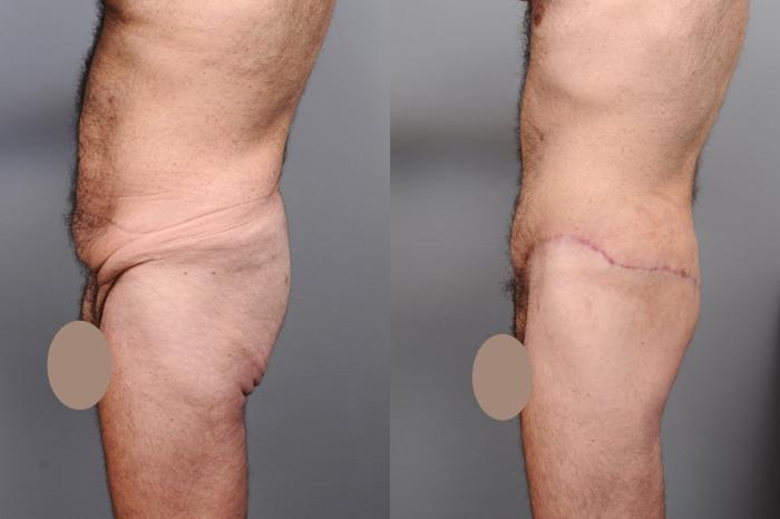 Before & After Lower Body Lift for Men Case 132 View #3 View in New York, NY