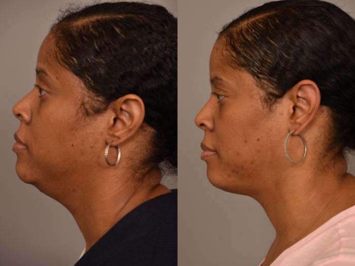 Before & After Mini Neck Lift (Single Incision) Case 258 Left Side View in New York, NY
