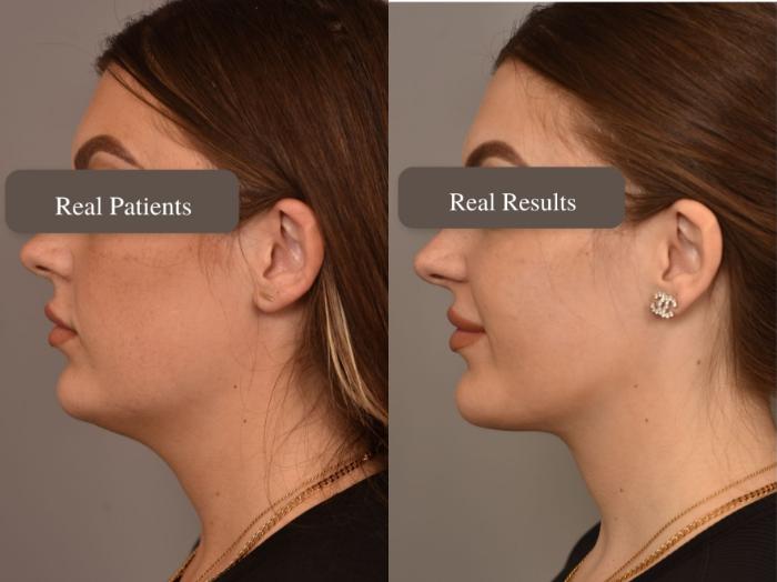 Before & After Mini Neck Lift (Single Incision) Case 259 Left Side View in New York, NY