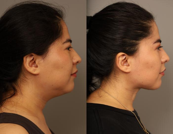 Mini Neck Lift improves profile of New York City Patients