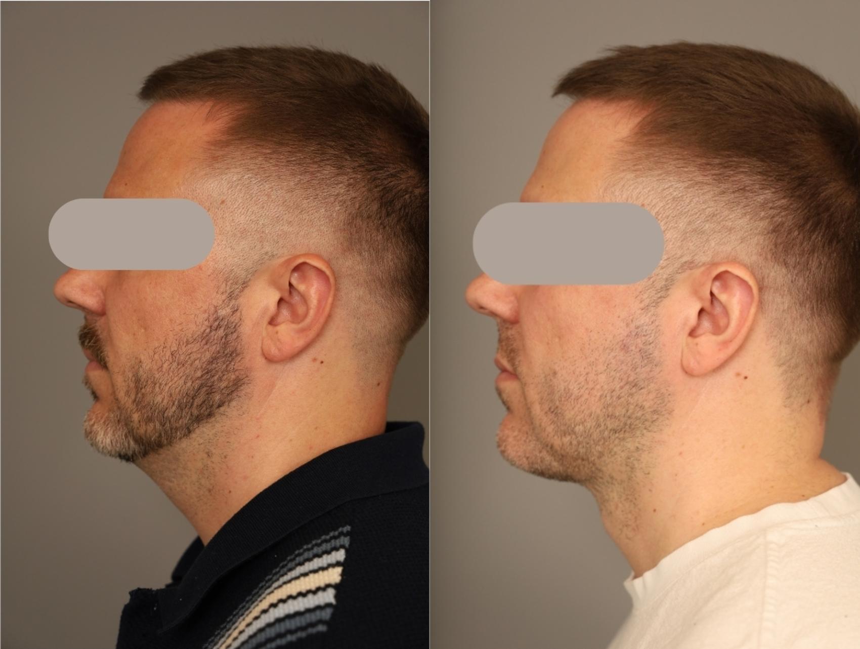 Before and After Male Deep Neck Lift NYC