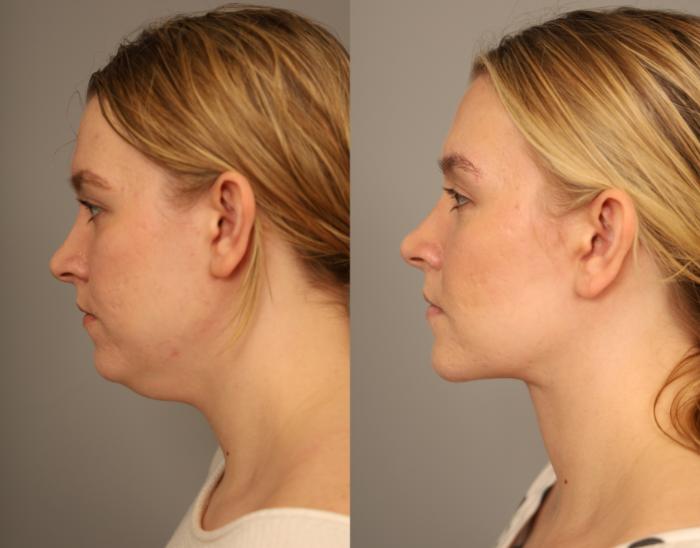 Before and After Mini Neck Lift performed through a single 1 inch incision