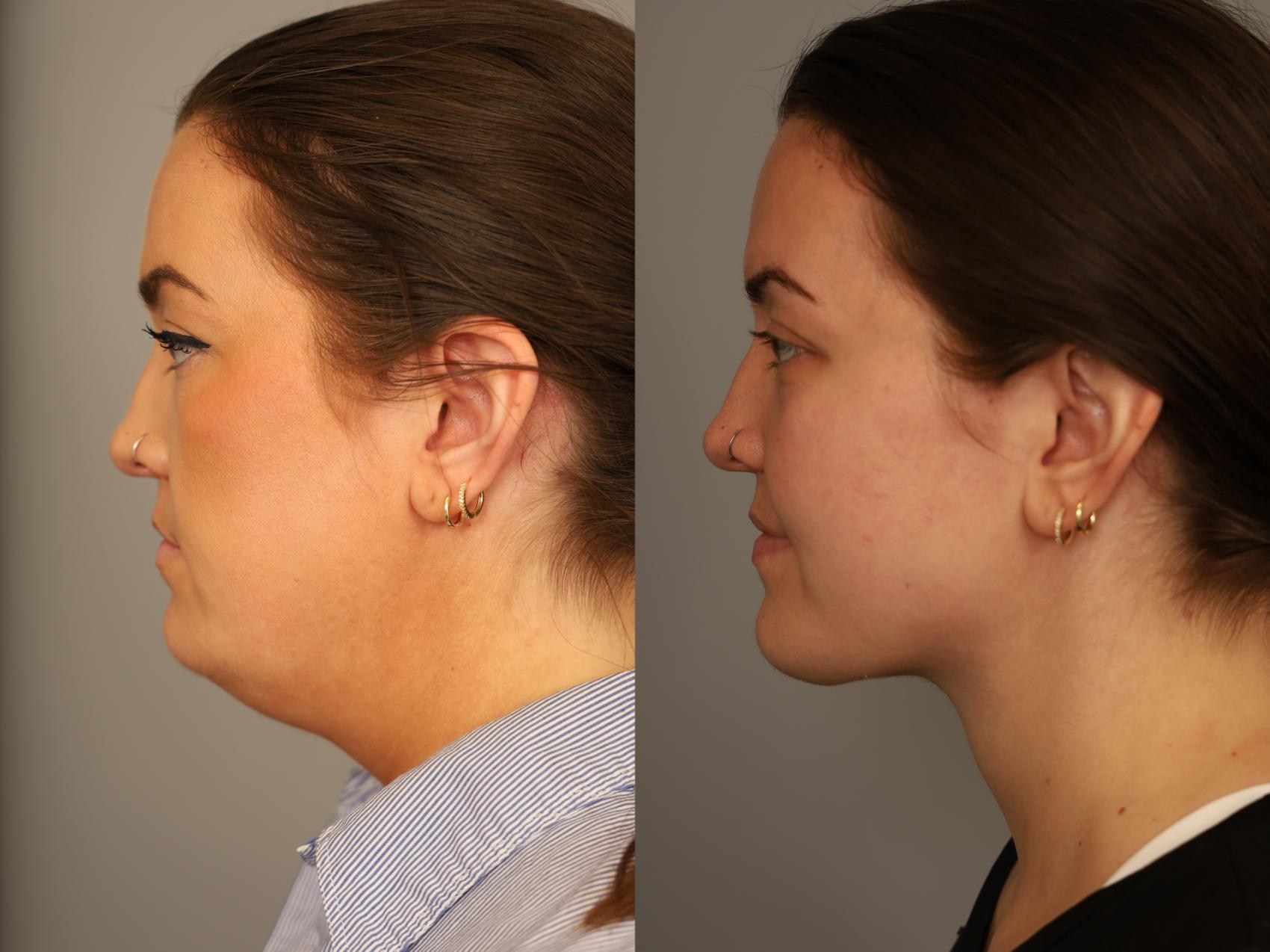 Before & After Mini Neck Lift (Single Incision) Case 323 Left Side View in New York, NY