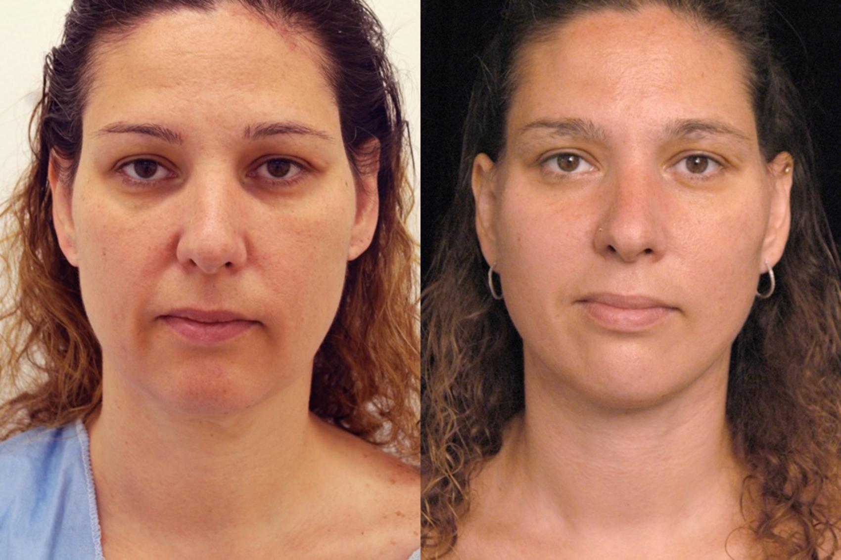 Before & After Naturalift™ Mini Facelift Case 77 View #1 View in New York, NY