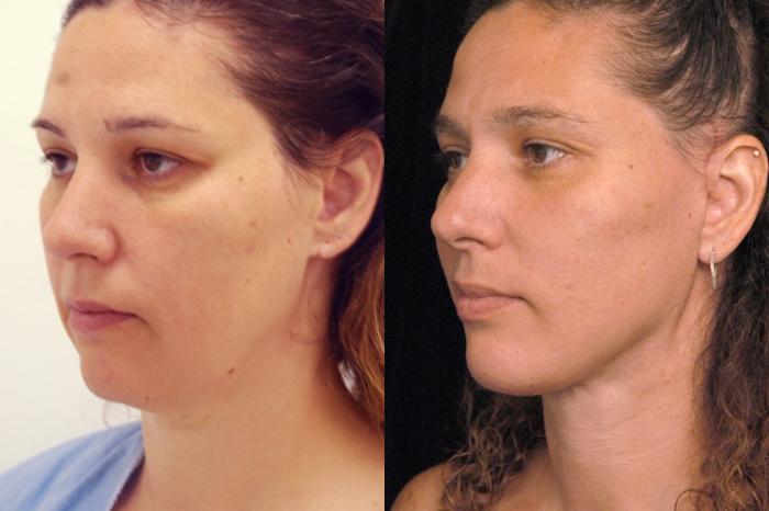 Before & After Naturalift™ Mini Facelift Case 77 View #2 View in New York, NY